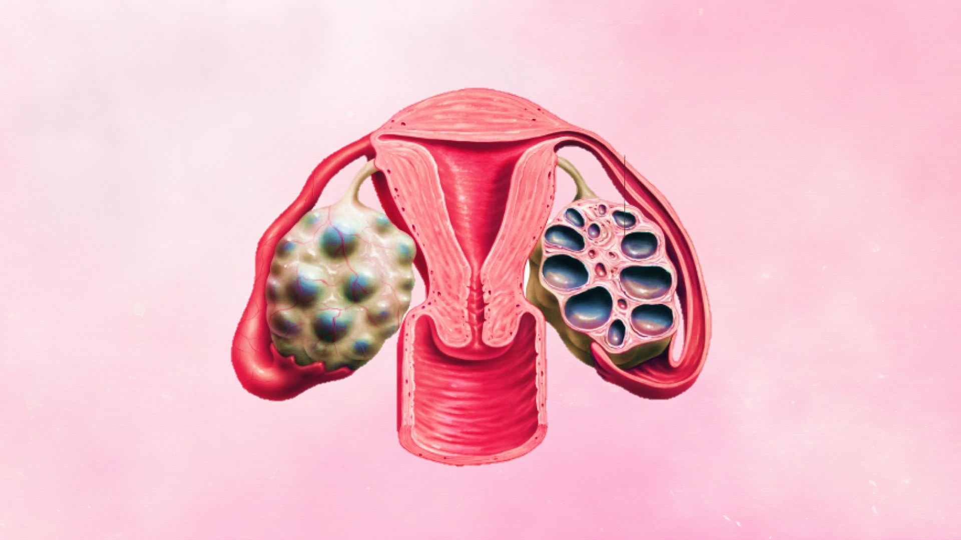 다낭성난소증후군 PCOS 여성질환 자궁 난소 명쾌한한의원 명쾌한최원장